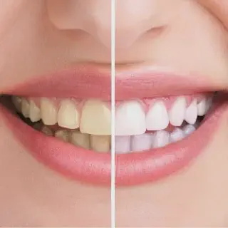 /img/30563-teeth-whitening-deals.webp