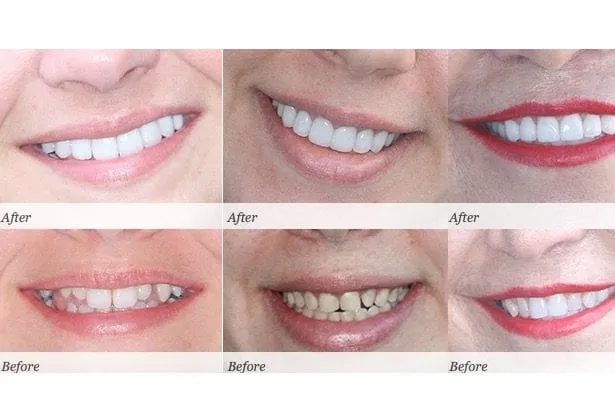 30563 teeth whitening maintenance