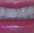 30566 tooth discoloration