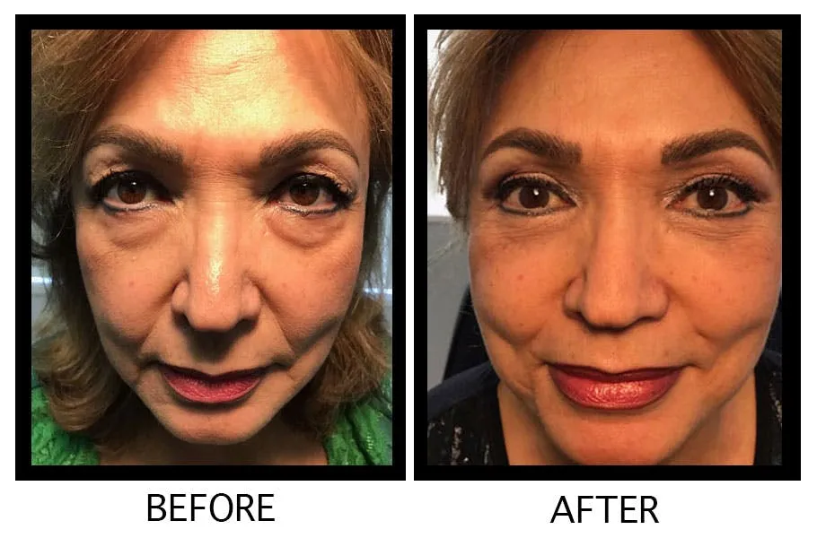 30577 eye whitening cost uk