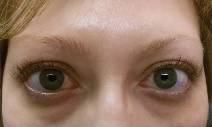 30577 eye whitening risks