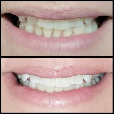 30579 teeth whitening des moines 2