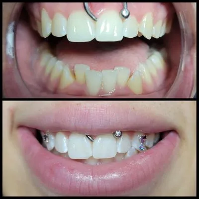 30579 teeth whitening des moines 3