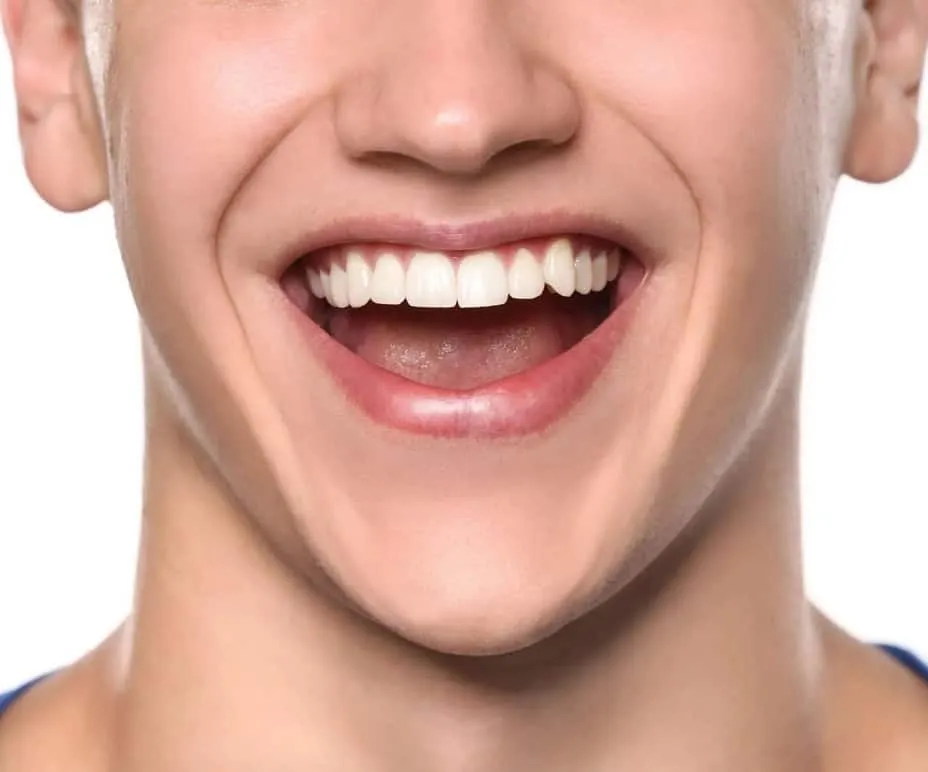 30579 teeth whitening des moines 5