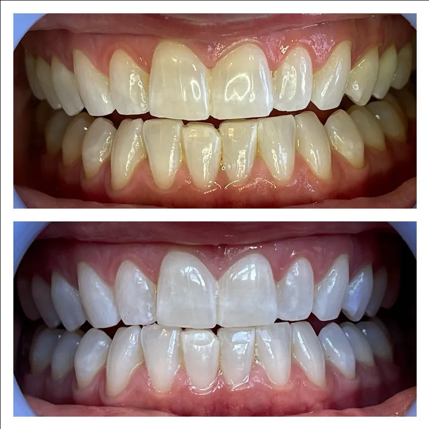 30580 utah teeth whitening image3