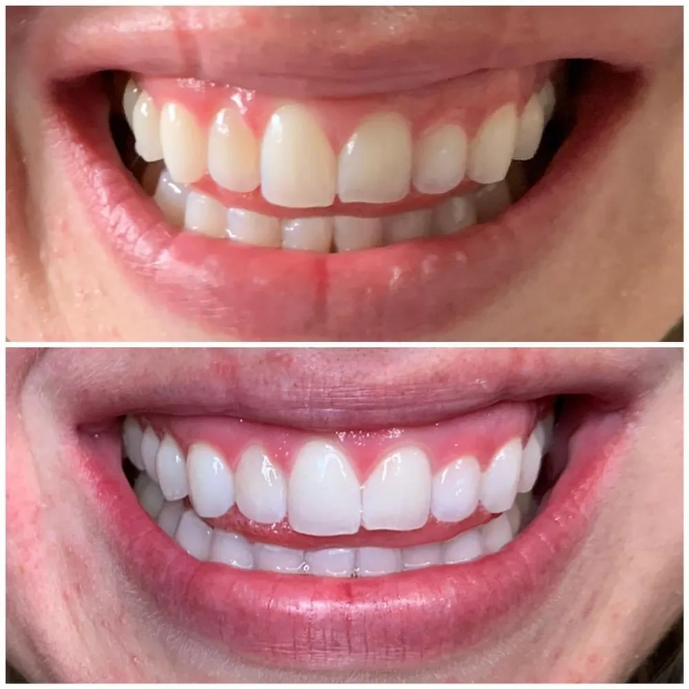30580 utah teeth whitening image4