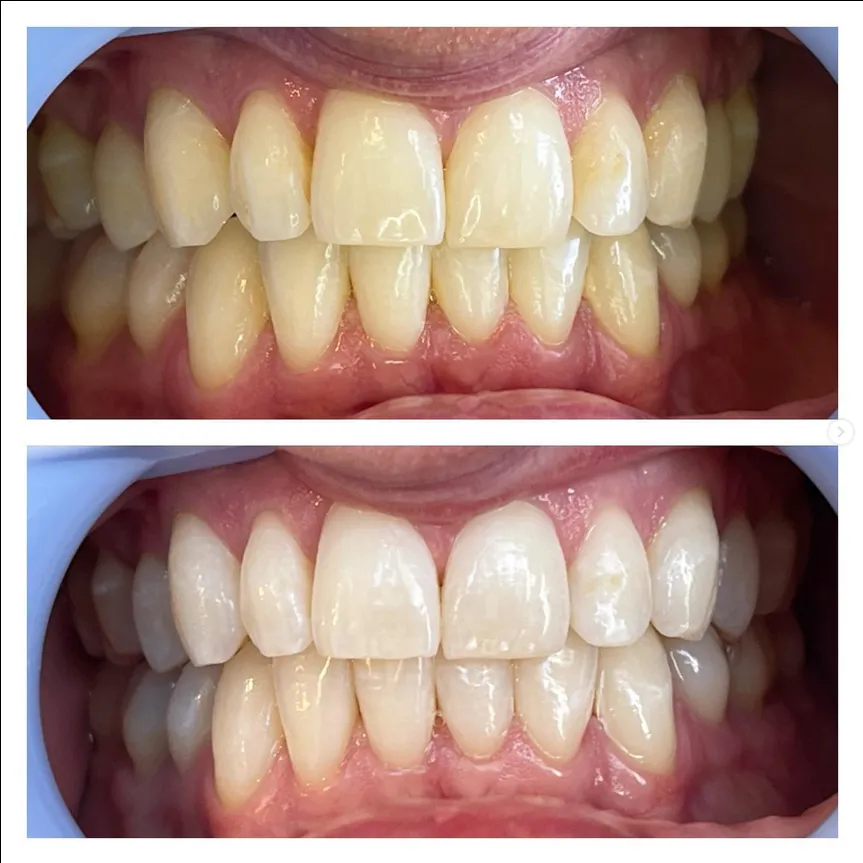 30580 utah teeth whitening image5