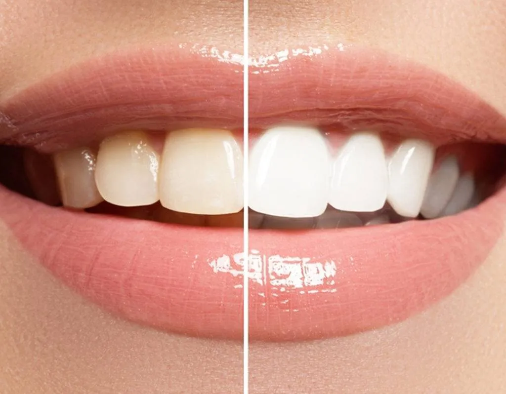 30585 professional teeth bleaching
