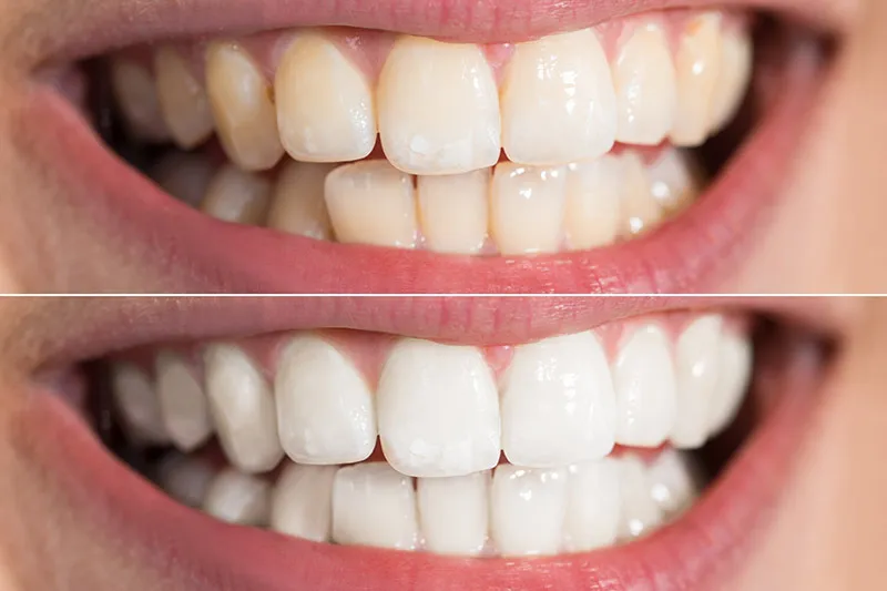 30586 zoom whitening vs options