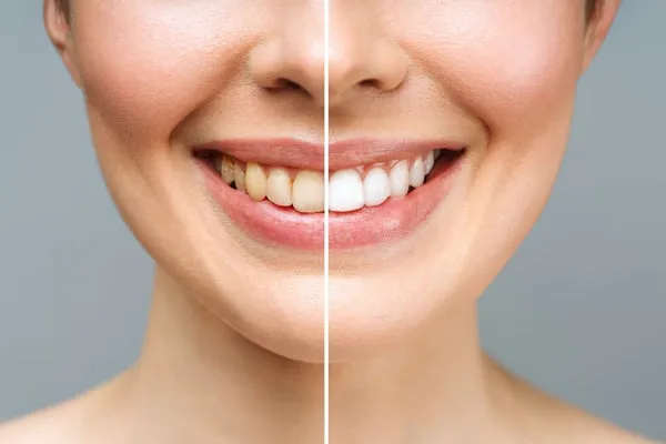 30587 tanning teeth whitening image3