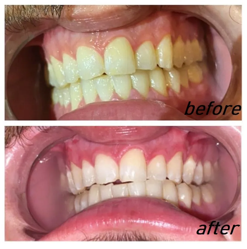 30587 tanning teeth whitening image4