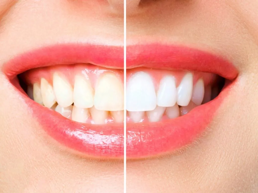 /img/30587-tanning-teeth-whitening-image7.webp