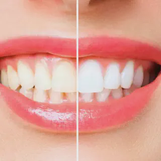 /img/30587-tanning-teeth-whitening-image7.webp