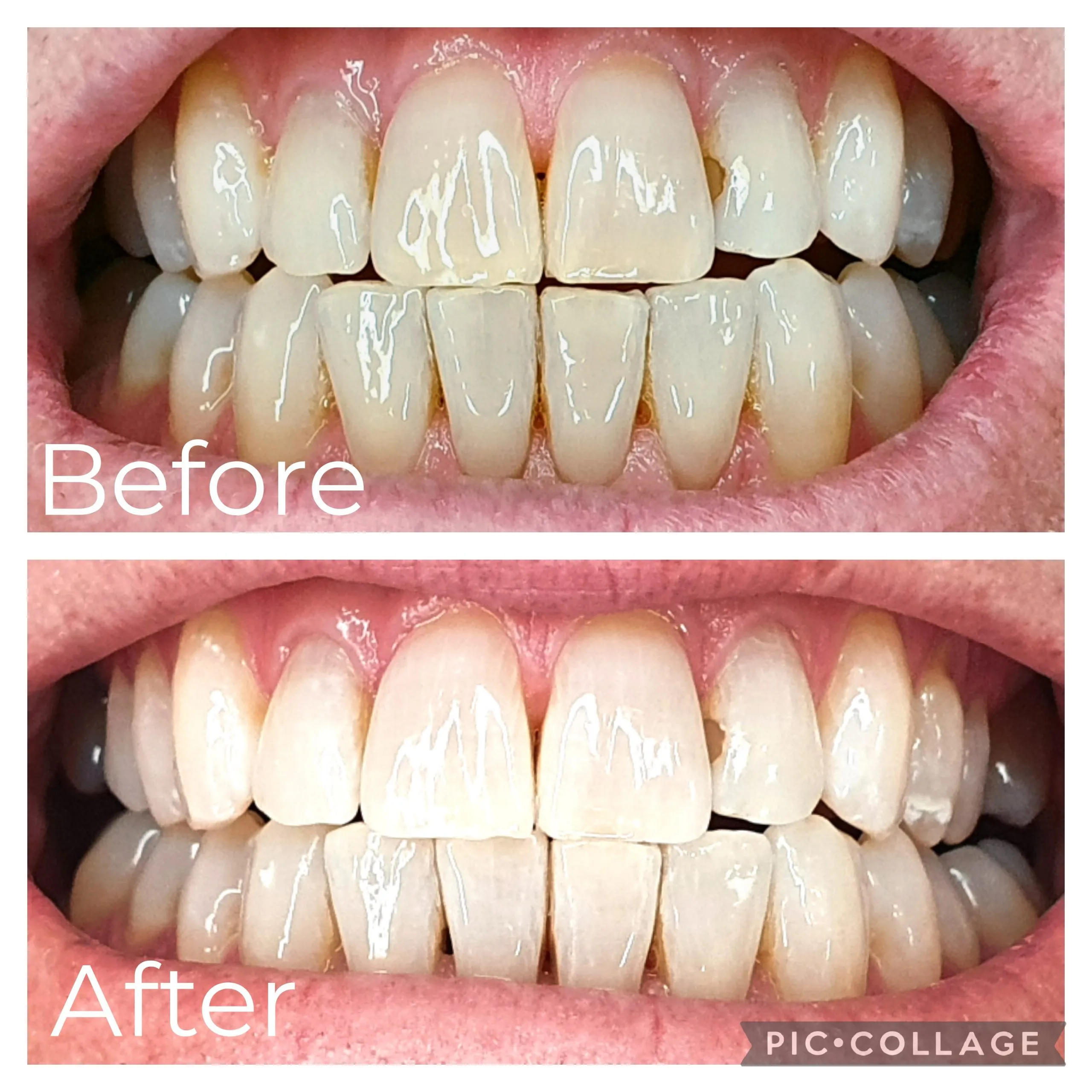 30589 professional teeth whitening
