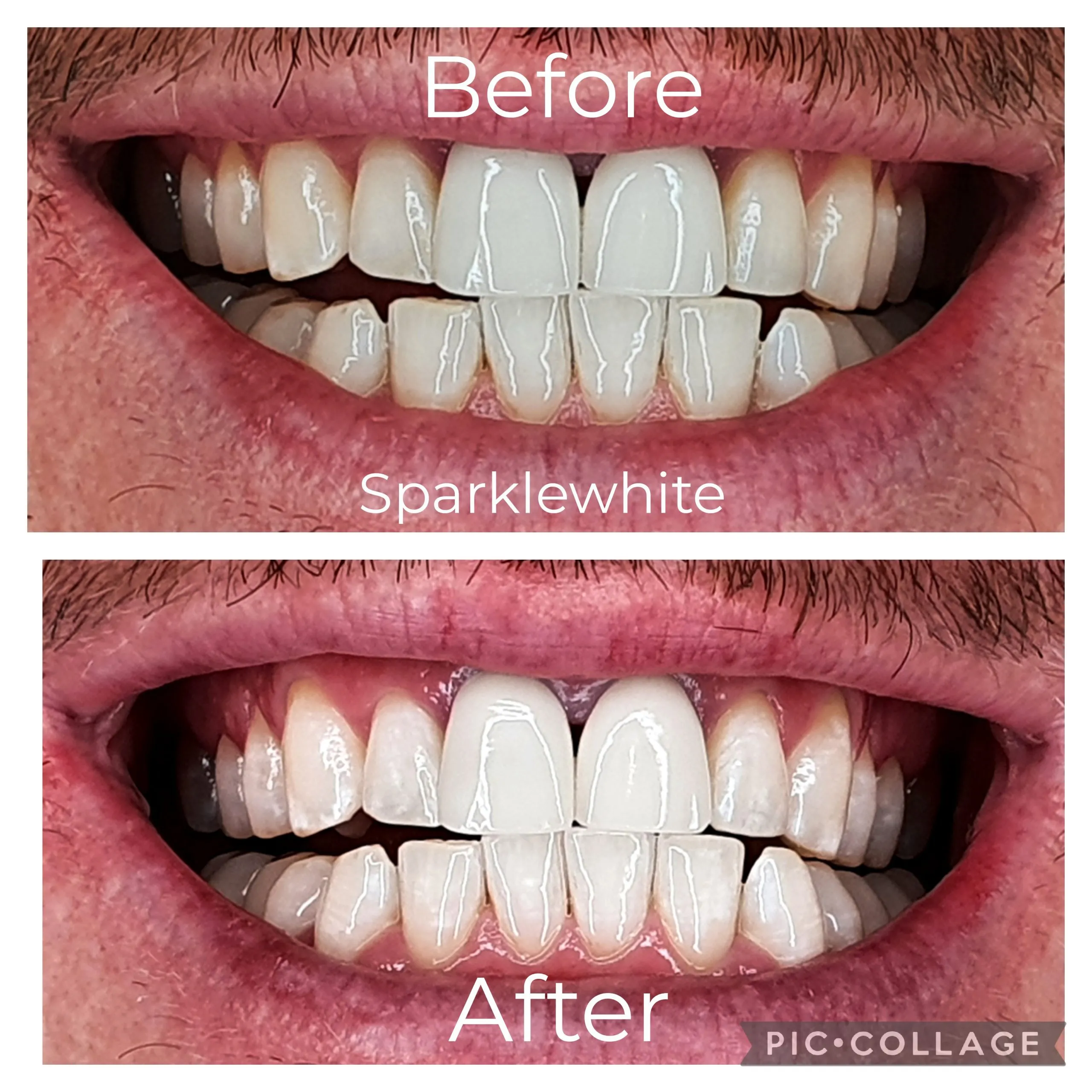 30589 teeth whitening company comparison