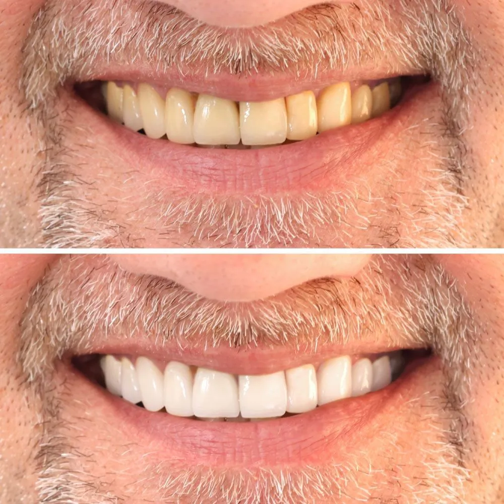 30590 teeth whitening massapequa image2