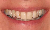 30590 teeth whitening massapequa image6