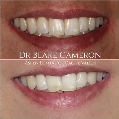 30592 in office teeth whitening