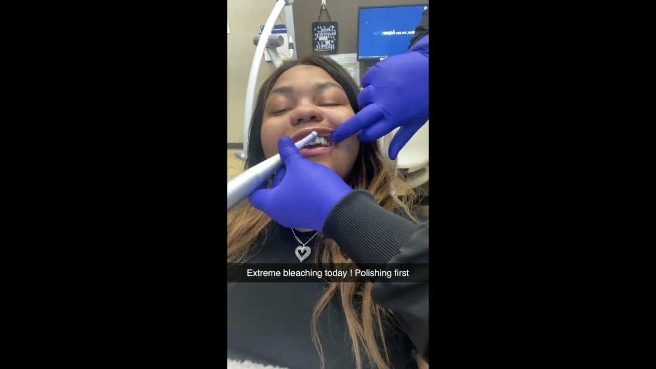 30592 teeth whitening results