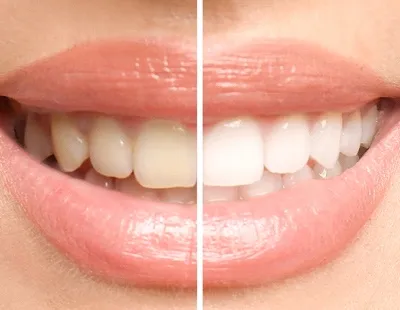30592 teeth whitening sensitivity