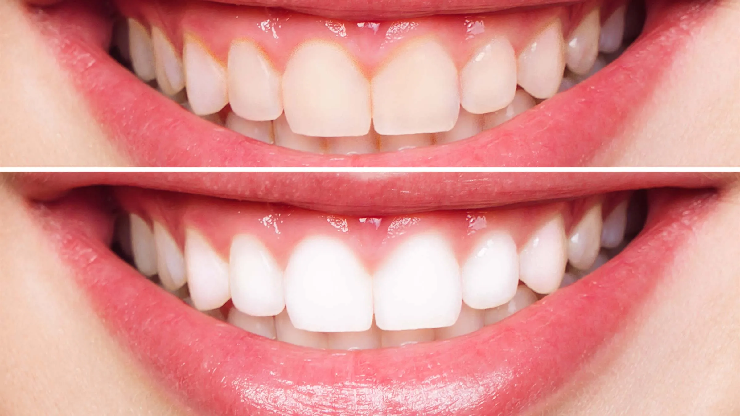 30595 teeth whitening options