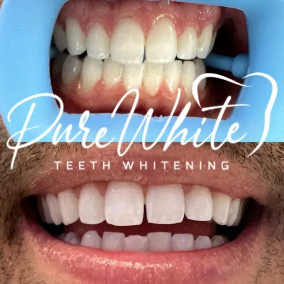 30599 teeth whitening party food drinks