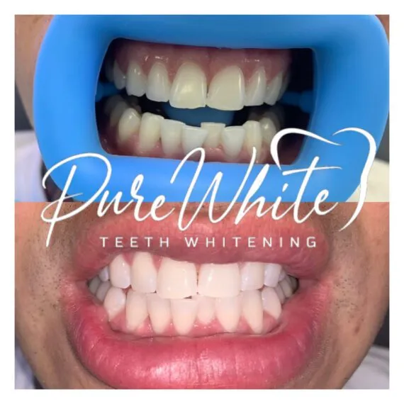 30599 teeth whitening party games