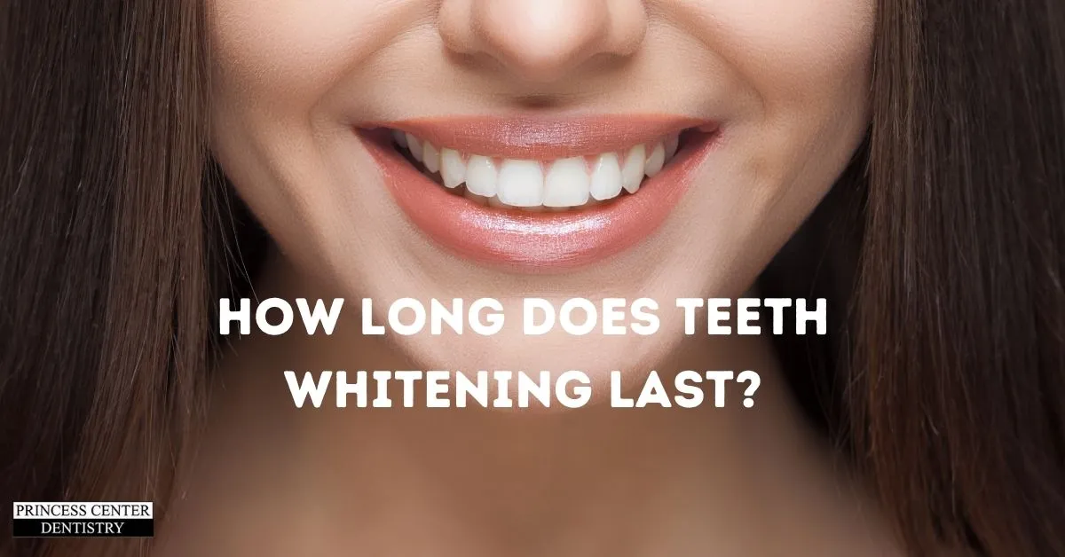 30600 teeth whitening before after