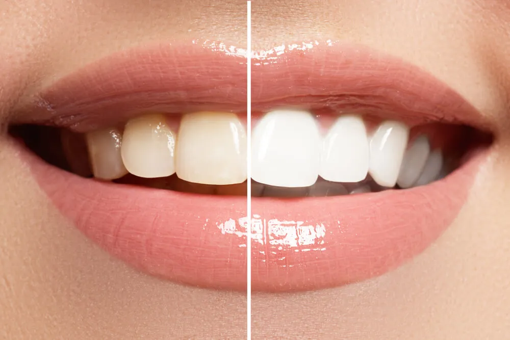 30600 teeth whitening food staining