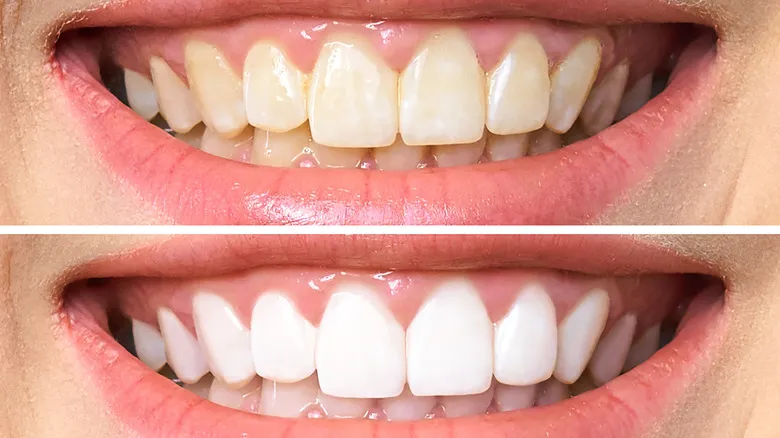 30603 zoom teeth whitening before after