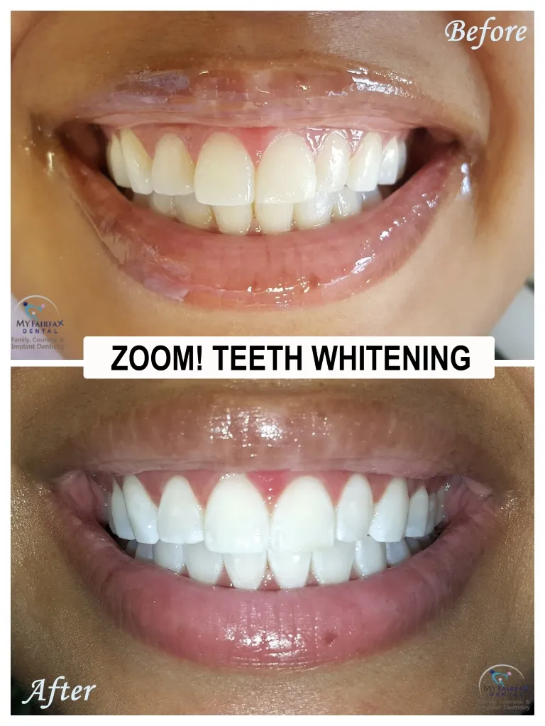 /img/30603-zoom-teeth-whitening-results.webp