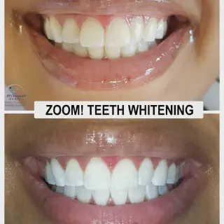 /img/30603-zoom-teeth-whitening-results.webp