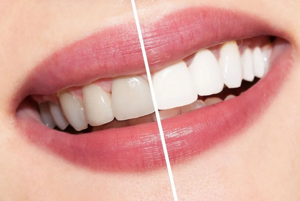30606 arizona teeth whitening before after