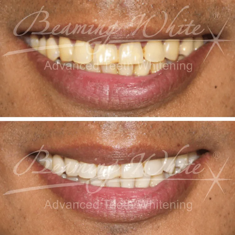 30606 arizona teeth whitening cost factors