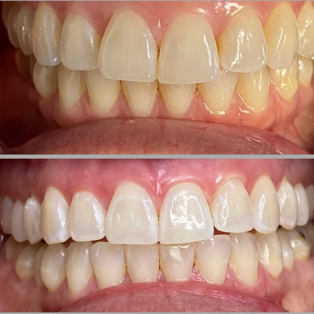 30606 arizona teeth whitening diet