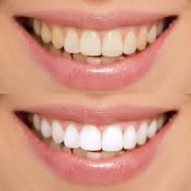 30606 arizona teeth whitening in office