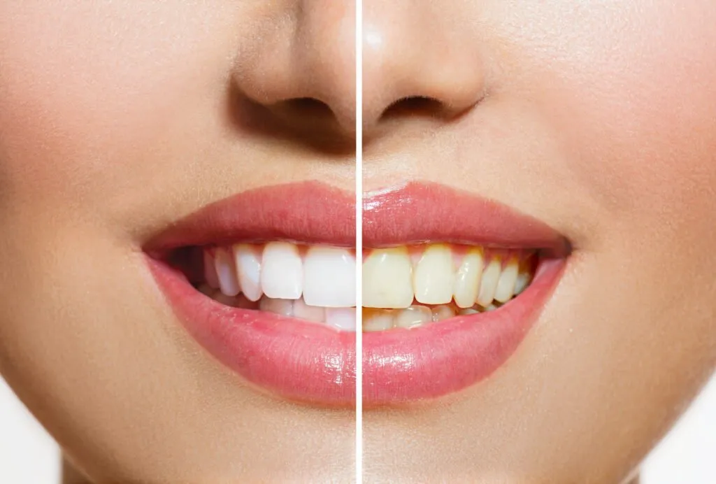 30606 arizona teeth whitening sensitivity