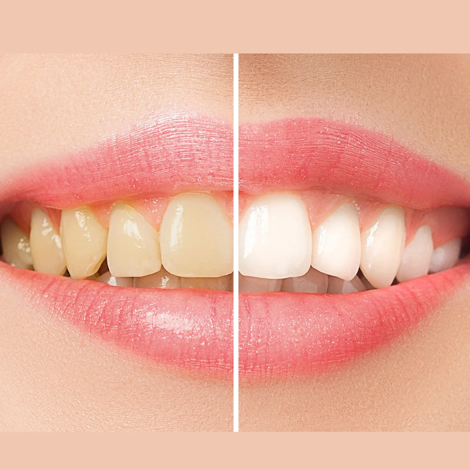 30610 laser teeth whitening