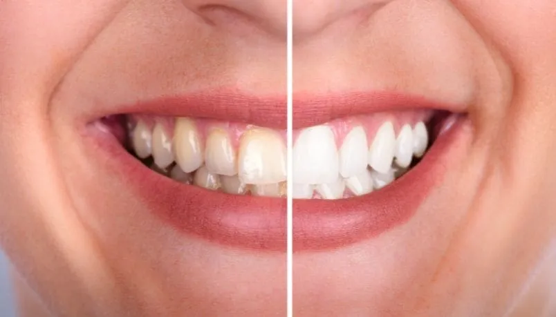 30615 teeth whitening psl healthy gums