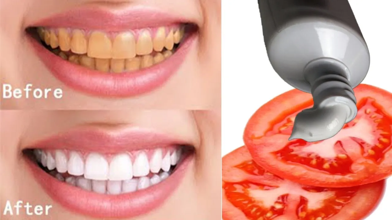 30621 tomato teeth whitening before after