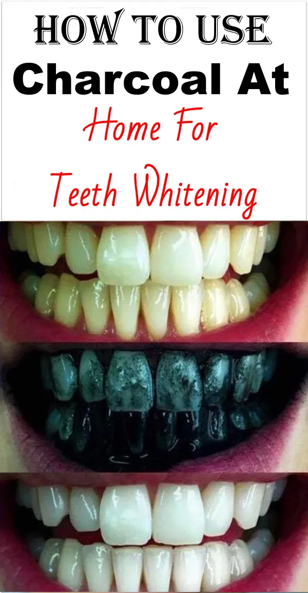 30623 charcoal teeth whitening 1