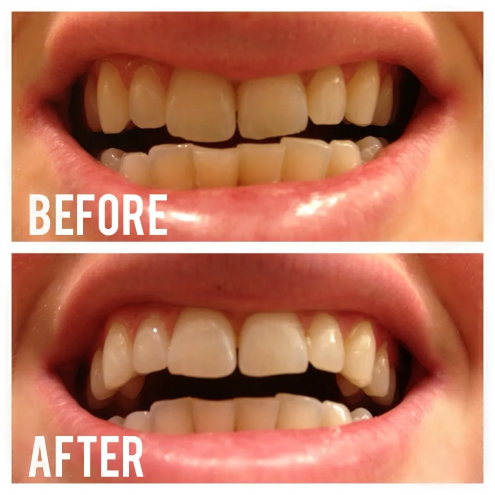 30623 charcoal teeth whitening 4