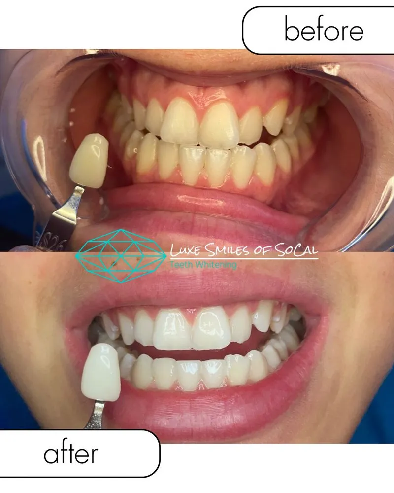 30626 teeth whitening application