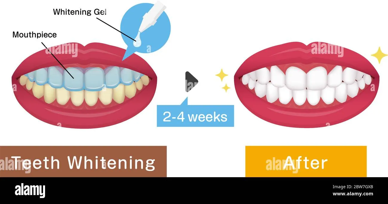 30630 at home teeth whitening vector