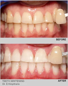 30632 dental school whitening