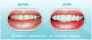 30632 in office whitening