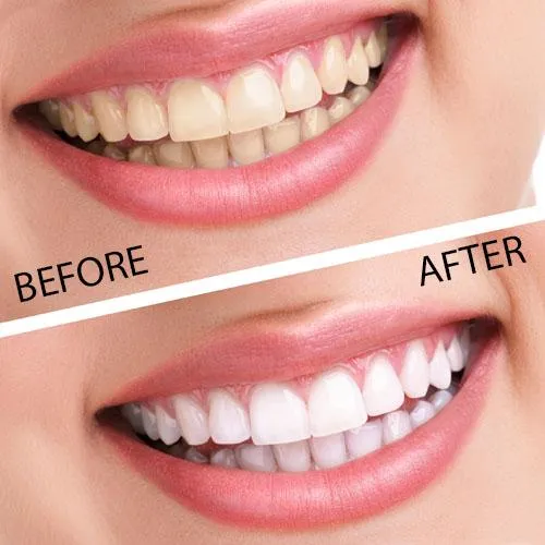 30632 over the counter whitening