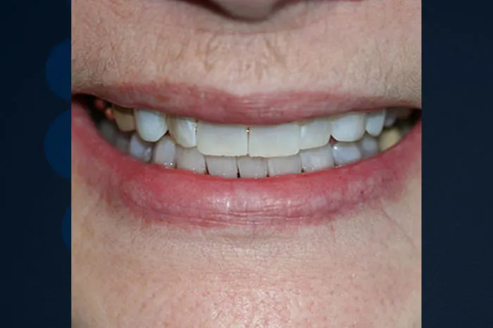30633 teeth whitening lexington ky image4