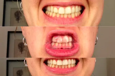 30641 strawberries for teeth