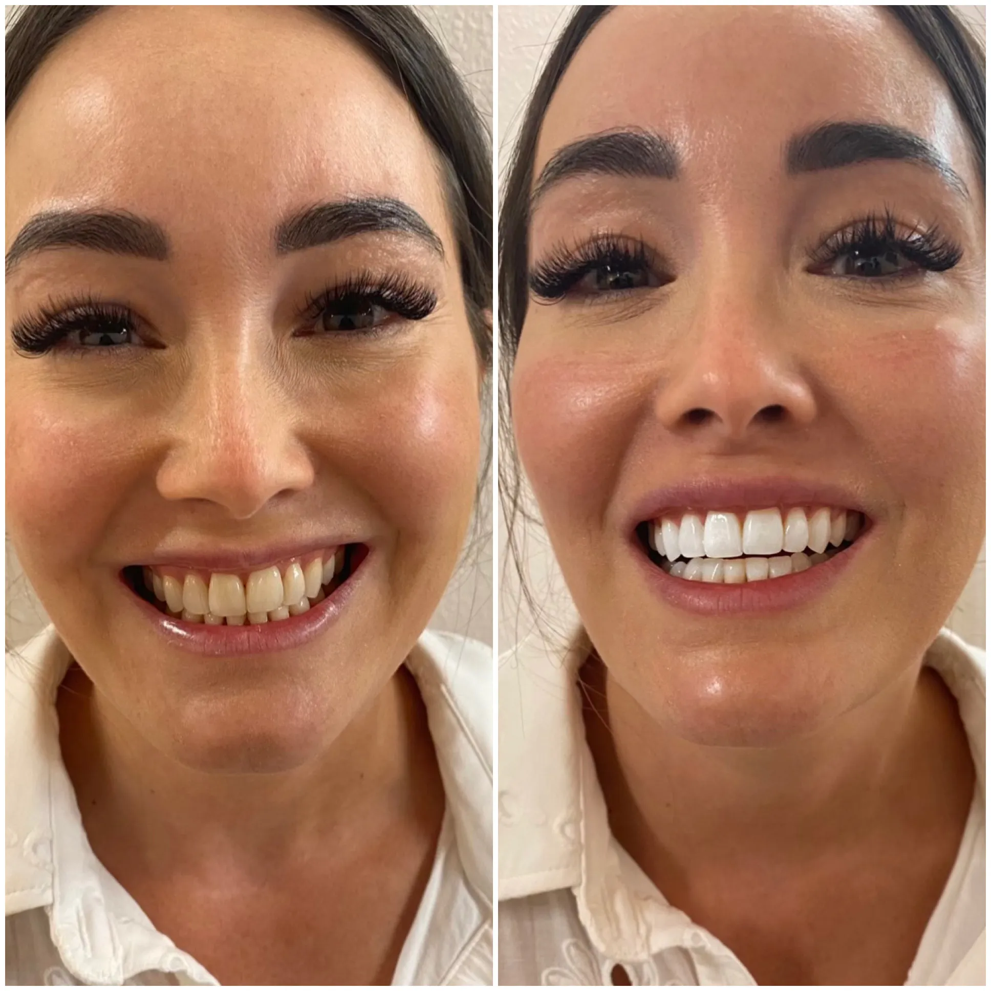 30641 strawberry teeth whitening after